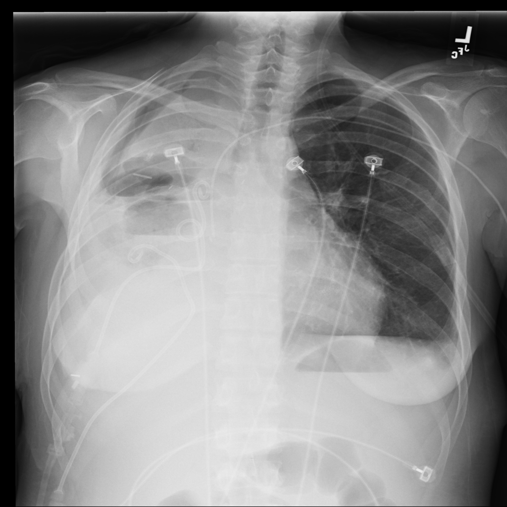 Pleural Effusion representative X-ray