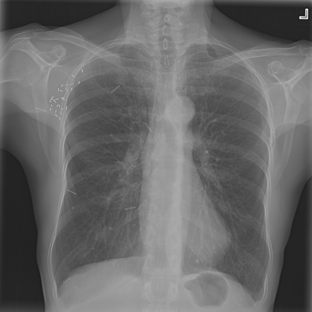 Nodule representative X-ray