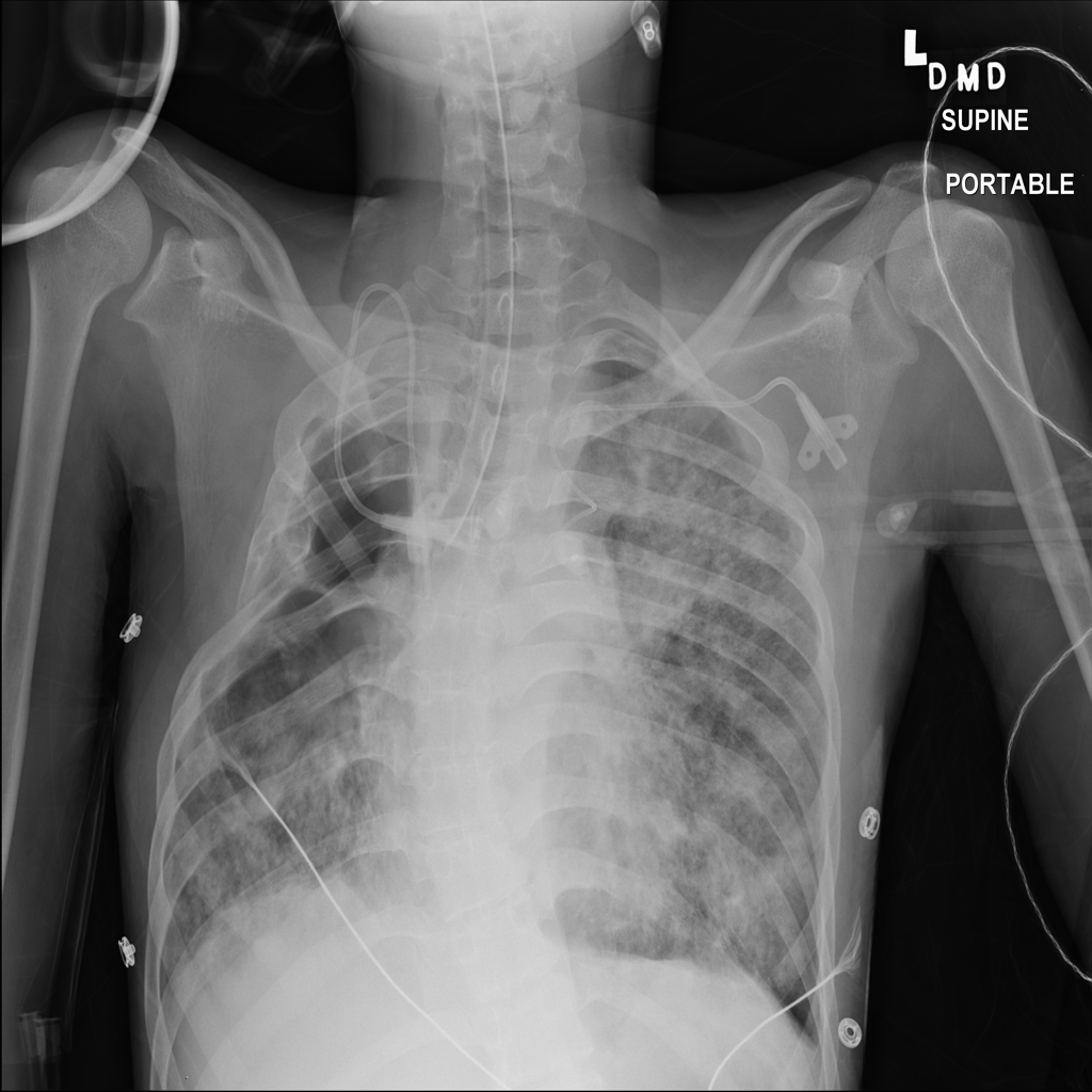 Pneumothorax representative X-ray